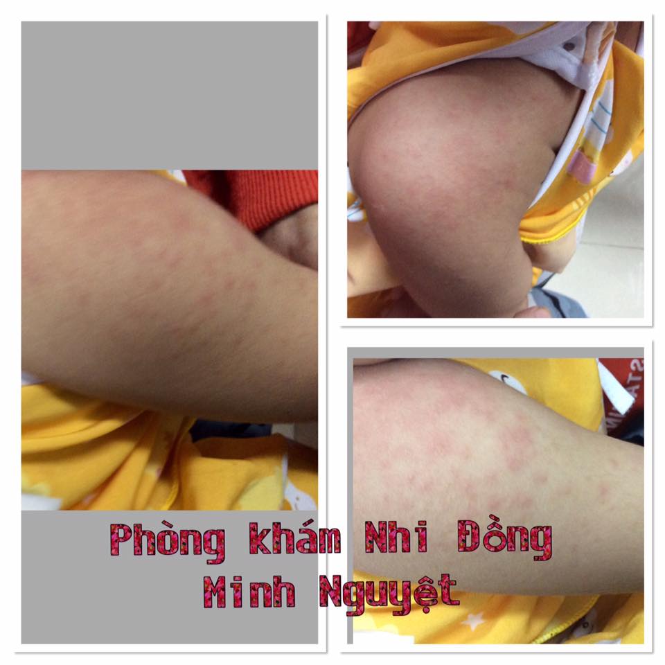 BỆNH TAY CHÂN MIỆNG (Hand, Foot, and Mouth Disease)